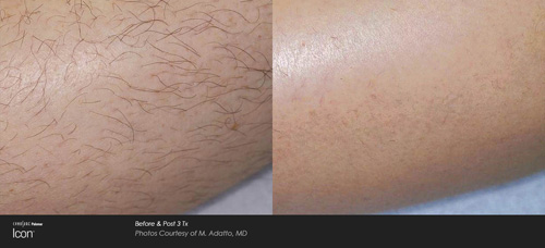 Laser Hair Removal
