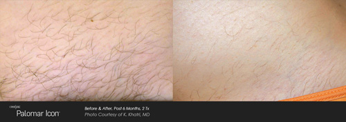 Laser Hair Removal