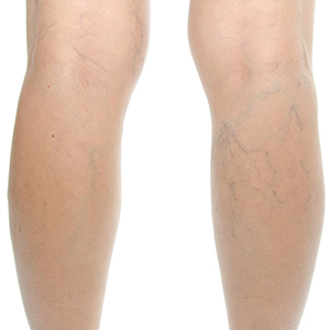 Sclerotherapy