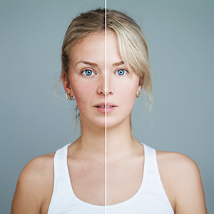 Intense Pulsed Light (IPL)